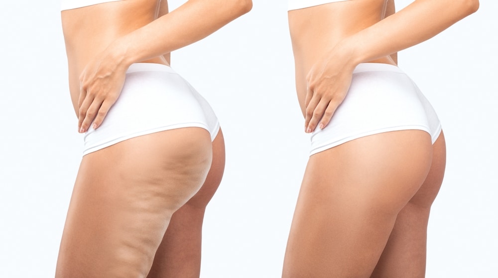 Cellulite Reduction & Body Contouring treatment at Boca Medical Aesthetics in Boca Raton