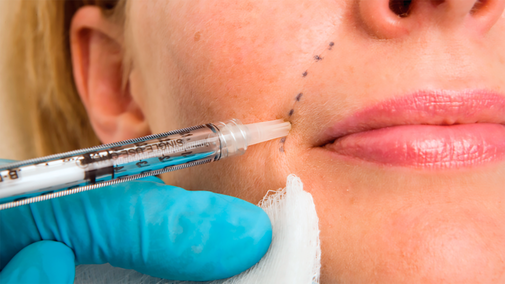 Dermal Fillers - Cheek Augmentation